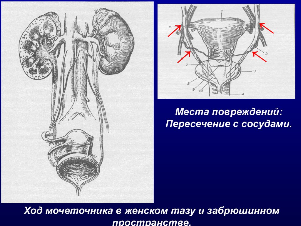 Вена артерия мочеточник. Ход мочеточника в женском тазу. Ход мочеточника и маточной артерии. Маточная артерия и мочеточник. Сужения мочеточника топографическая анатомия.