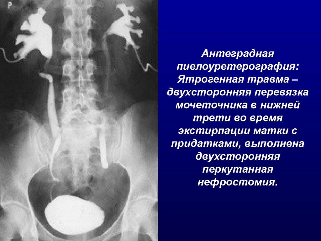 Рентген мочеточника. Ретроградная пиелография. Травма почки ретроградная пиелография. Разрыв мочеточника рентген. Антеградная (нисходящая) пиелоуретерография.