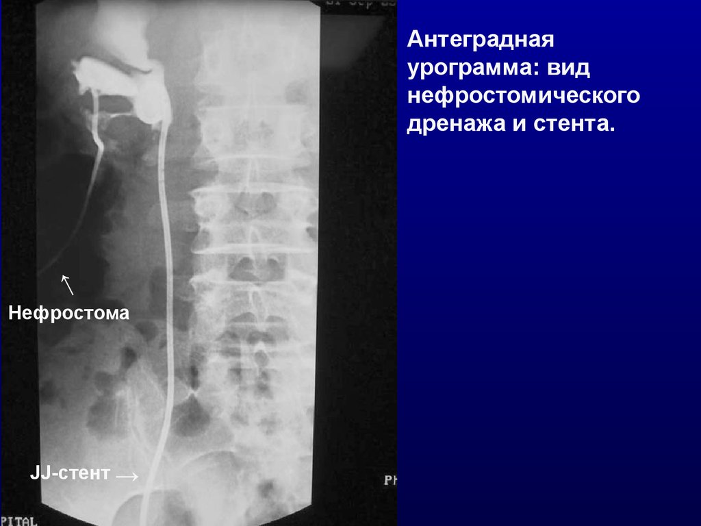 Травма мочеточника