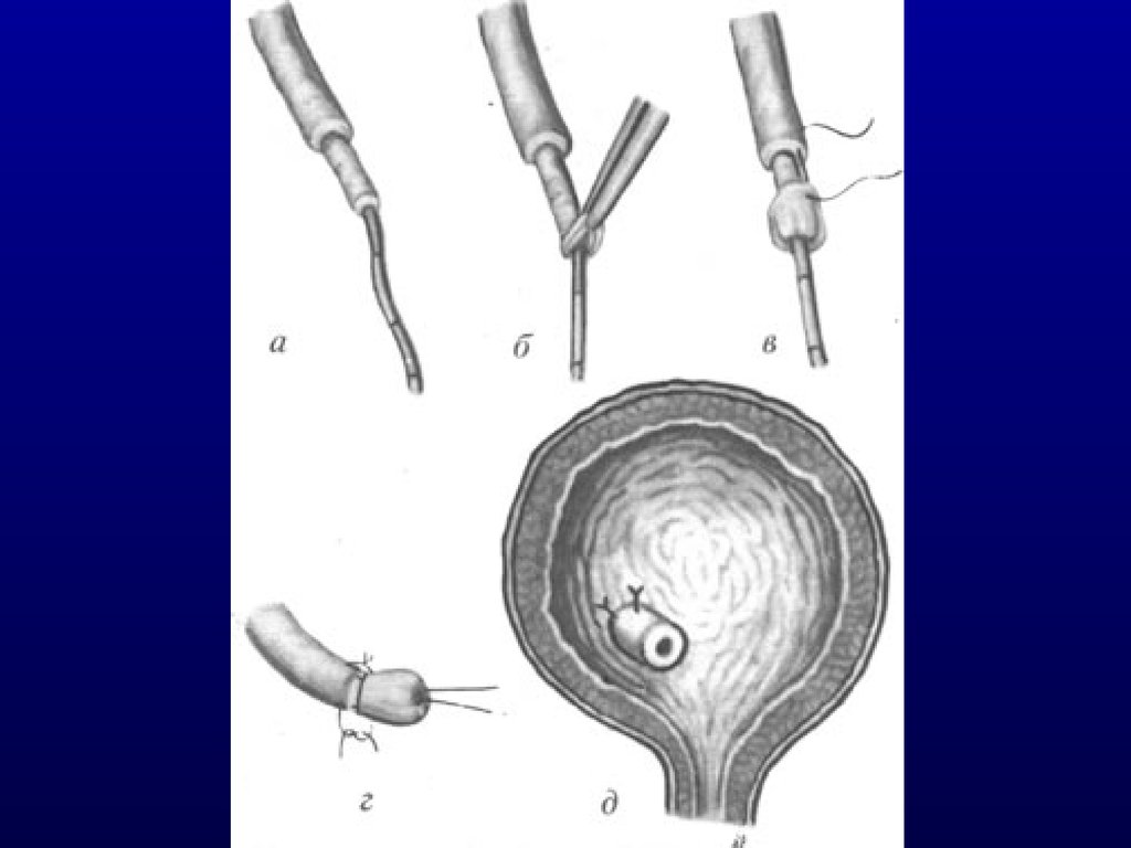 Камень в стенте мочеточника. Эктопия устьев мочеточников это. Эндопластика устья мочеточника. Реимплантация мочеточника в мочевой пузырь.