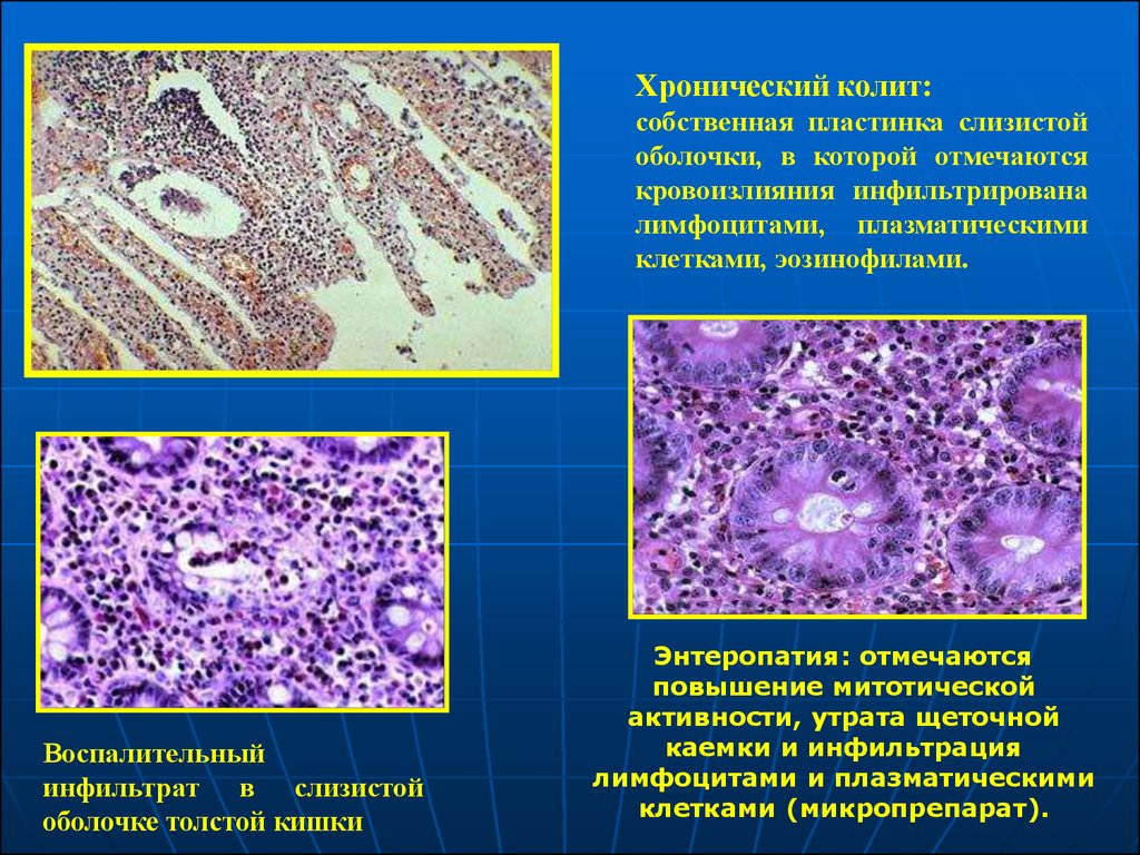 Хронический колит. Лимфоплазмоцитарная инфильтрация гистология. Хронический колит гистология. Эозинофильный энтерит гистология. Эозинофильный колит гистология.