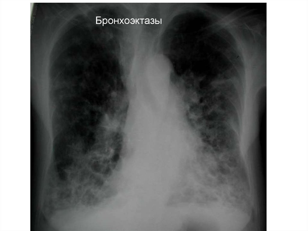 Рентген картина бронхоэктазов