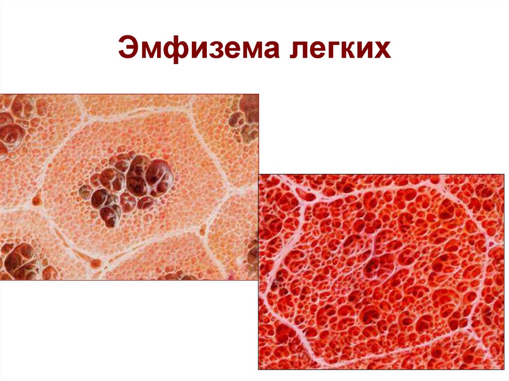 Эмфизема легких что это такое. Первичная эмфизема легких.