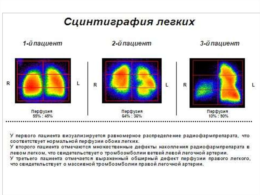 Что такое сцинтиграфия