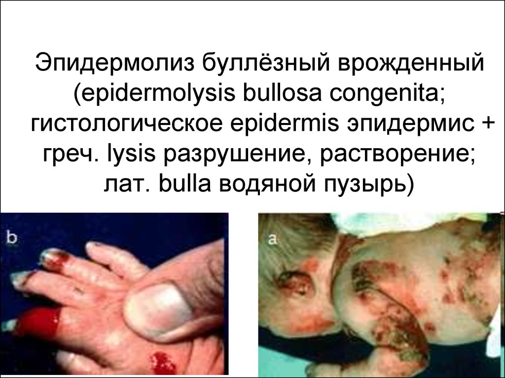 Эпидермолиз буллёзный врожденный (epidermolysis bullosa congenita; гистологическое epidermis эпидермис + греч. lysis разрушение, растворение; лат. bulla водяной пу