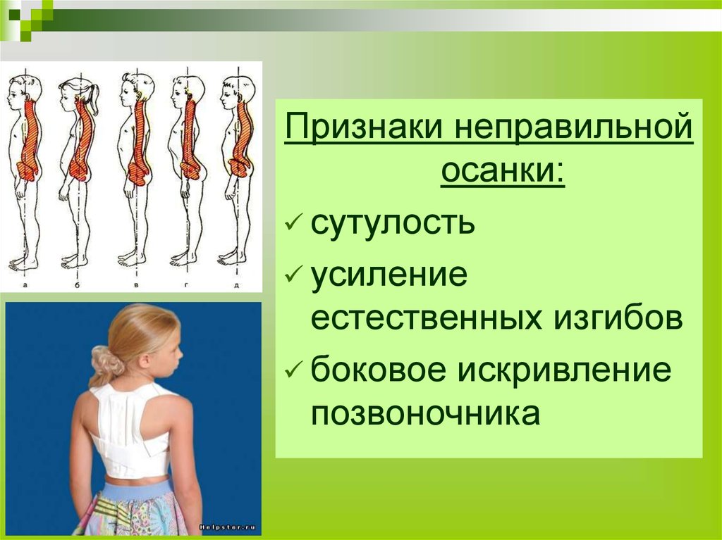 Осанка. Неправильная осанка. Признаки неправильной осанки. Признаки не правильннойосанки. Неправильная осанка искривление позвоночника.