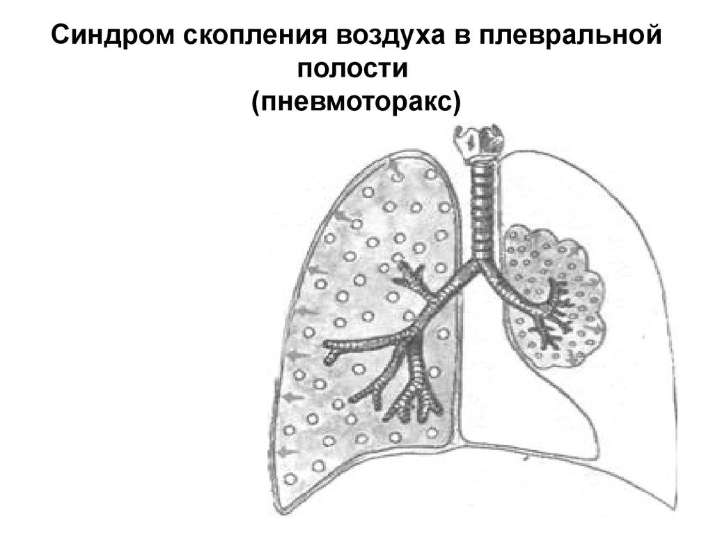 Синдром скопления жидкости. Синдром скопления воздуха в плевральной полости (пневмоторакс). Пневмоторакс – наличие воздуха в плевральной полости.. Синдром скопления воздуха в полости плевры (пневмоторакс).. Синдром наличия воздуха в плевральной полости (пневмоторакс)..