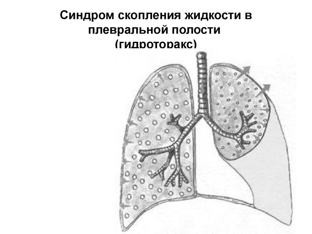 Жидкость гидроторакс. Синдром скопления жидкости в плевральной полости. Гидроторакс плевральная жидкость. Синдром наличия жидкости в плевральной полости пропедевтика. Синдром скопления жидкости в плевральной полости пропедевтика.