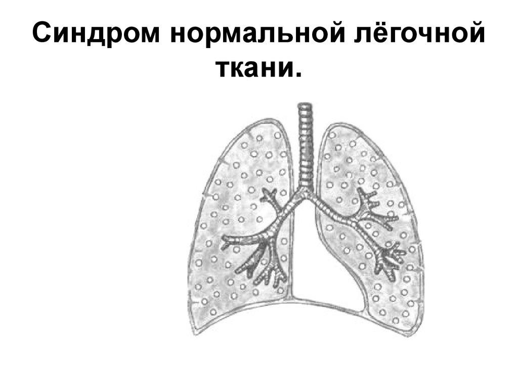 Уплотнение легочной ткани. Синдром нормальной легочной ткани. Синдром инфильтрации легочной ткани схема. Синдром уплотнения легочной ткани схема. Массивное уплотнение легочной ткани.