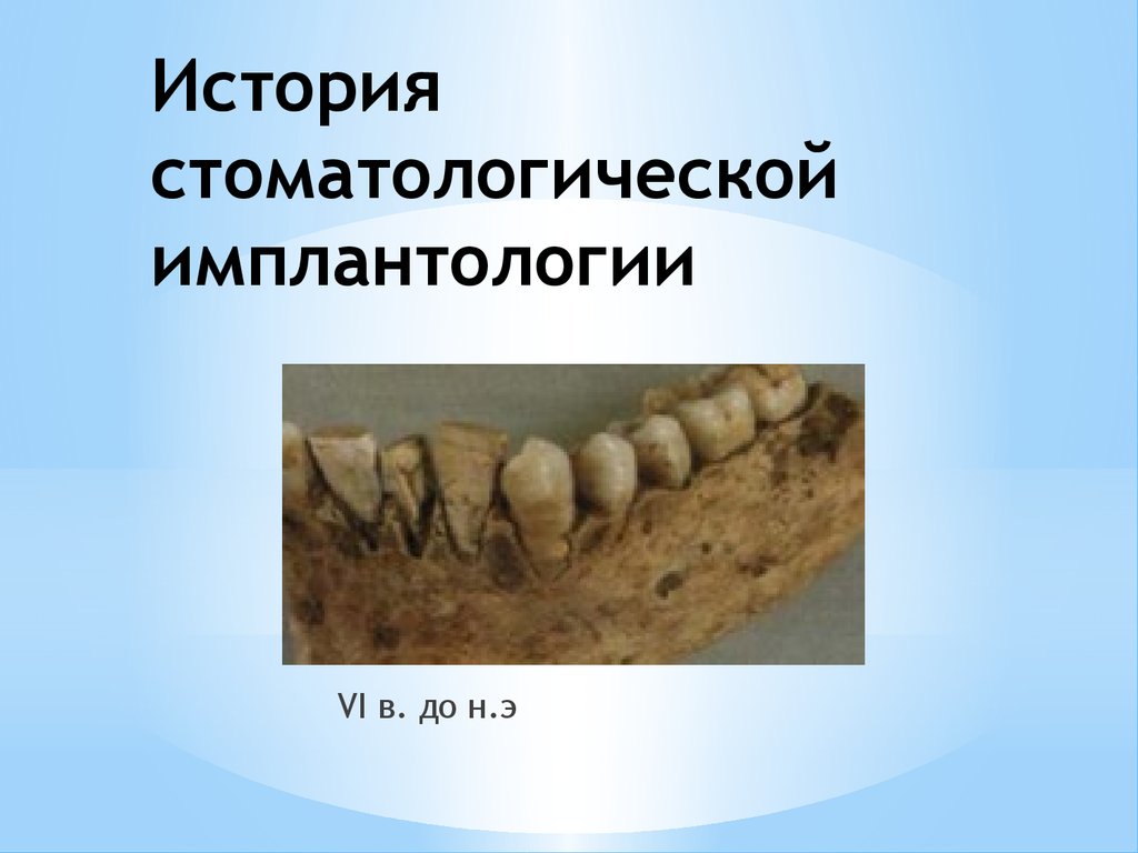 История имплантологии в стоматологии презентация