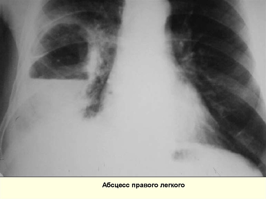 Абсцесс легкого. Дренированный абсцесс рентген. Абсцесс правого легкого рентгенограмма. Рентгенограмма гангренозный абсцесс. Абсцесс легкого недренированный.