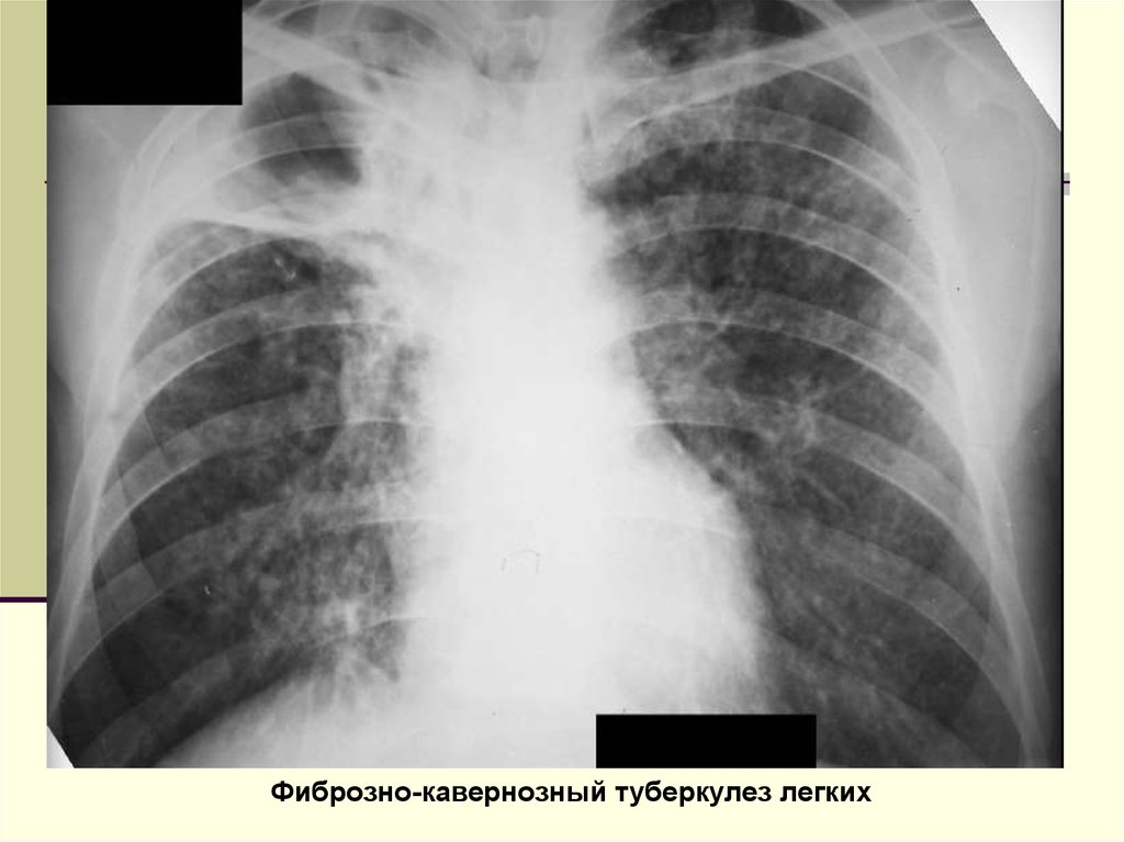 Фиброзно кавернозный туберкулез. Фиброзно кавернозный туберкулез рентгенограмма. Фиброзно-кавернозный туберкулез рентген. Фибро кавернозный туберкулез легких рентген. Фиброзно-кавернозный туберкулез легких рентген.