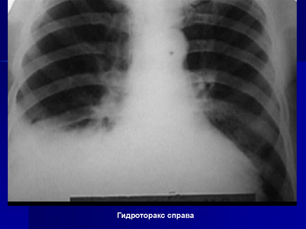 Гидроторакс это. Левосторонний Тотальный гидроторакс. Левосторонний реактивный малый гидроторакс. Гидроторакс справа рентген.