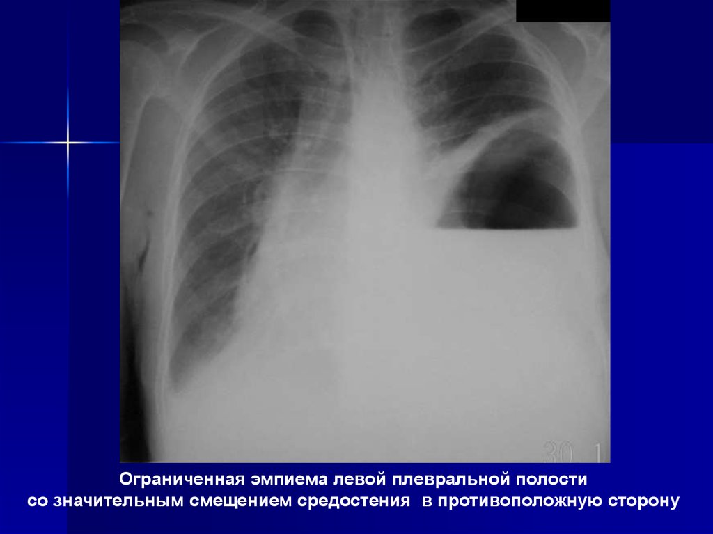 Почему на рентгеновском снимке изображение газа в плевральной полости черное