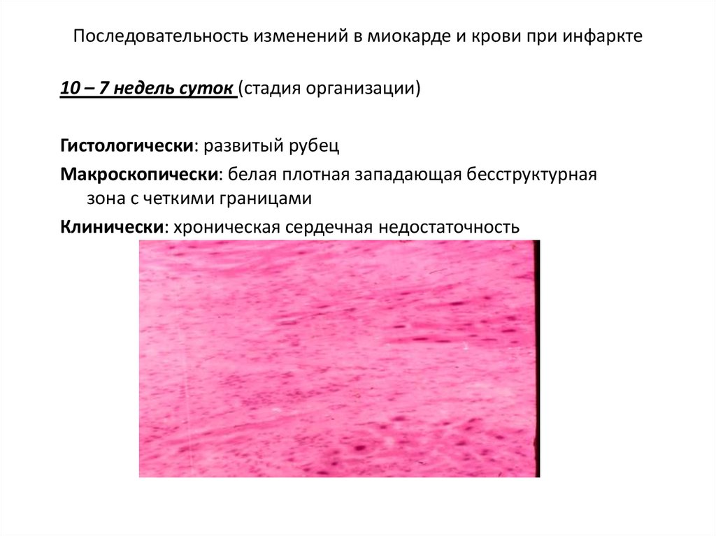 Изменение миокарда. Инфаркт миокарда в стадии организации микропрепарат. Макроскопическая характеристика инфаркта миокарда. Инфаркт миокарда в стадии организации макропрепарат описание. Макроскопическое описание инфаркта миокарда.