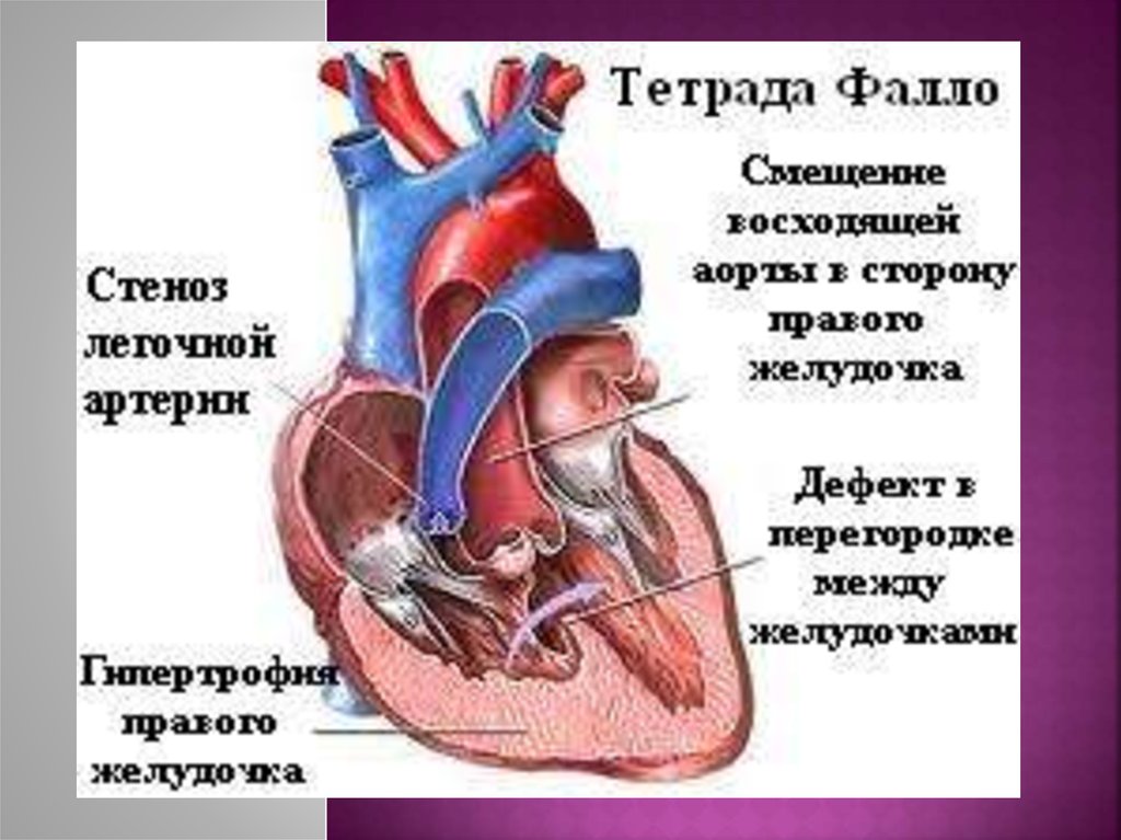 Тетрада фалло презентация педиатрия