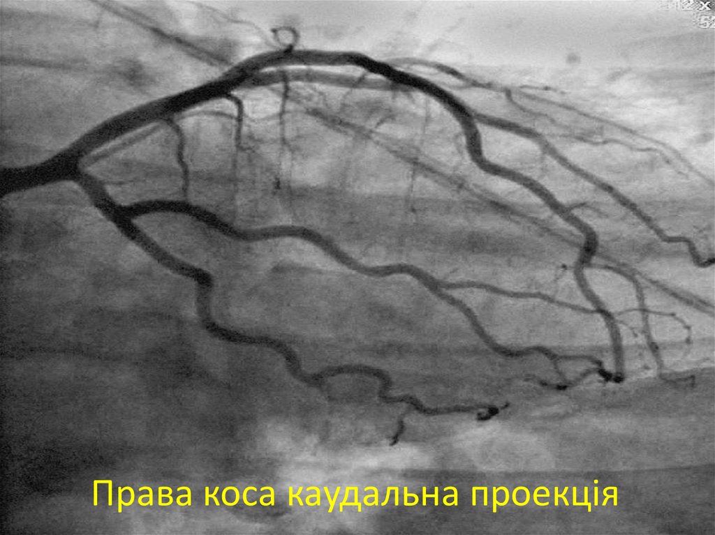 Права коса каудальна проекція
