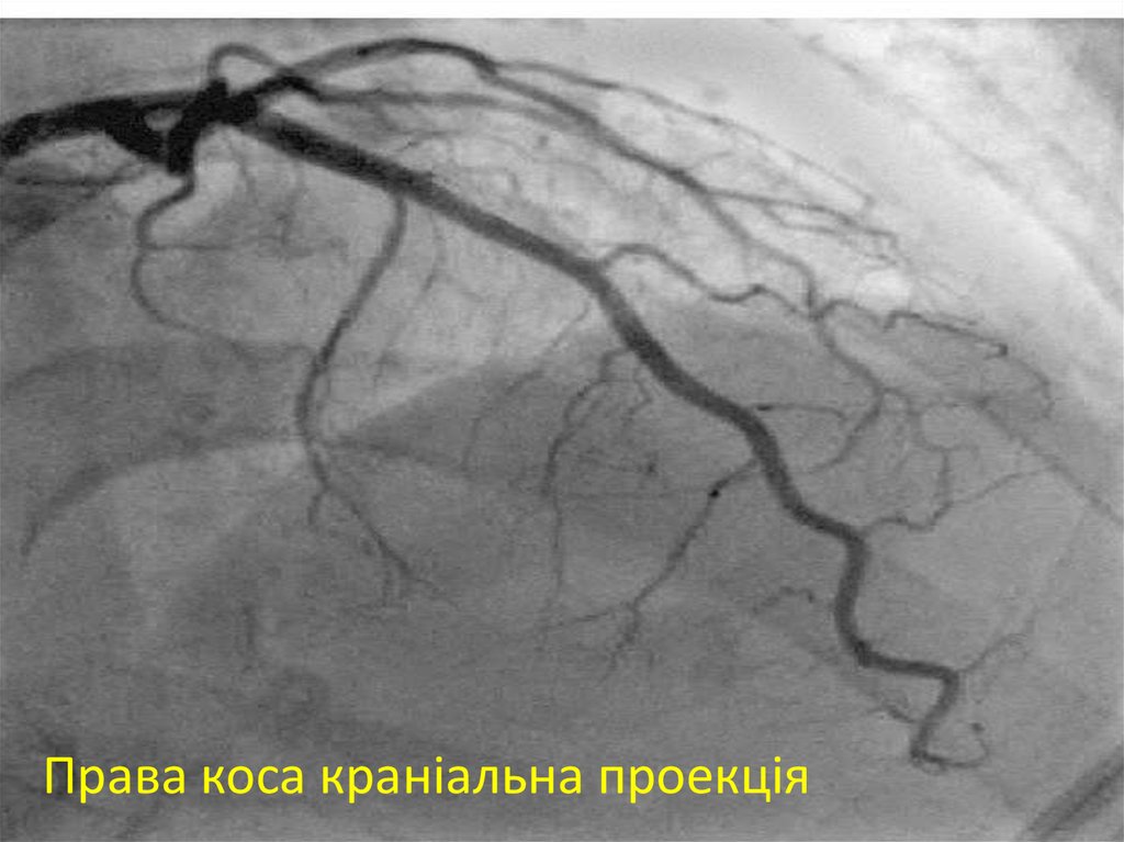 Права коса краніальна проекція