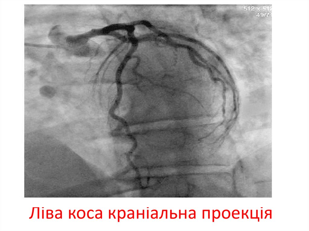 Ліва коса краніальна проекція