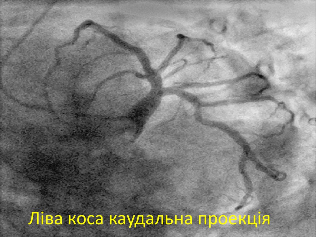 Ліва коса каудальна проекція
