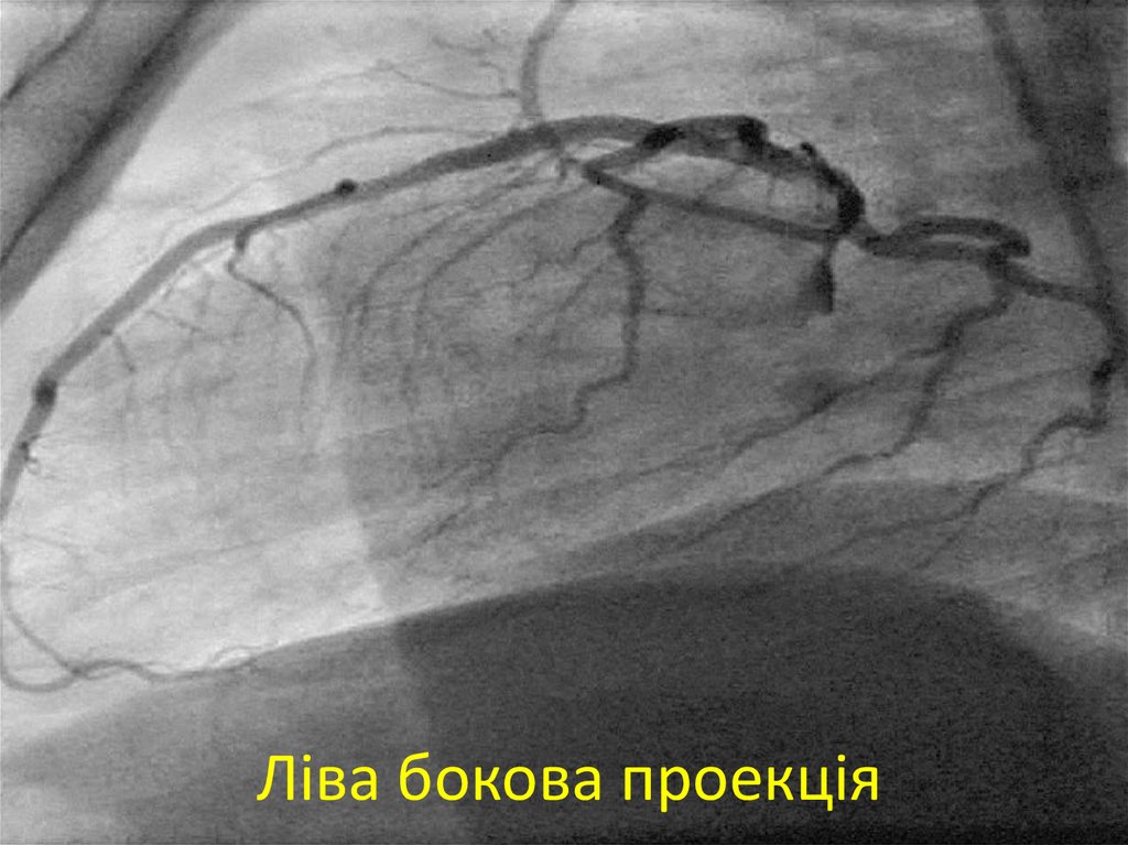 Ліва бокова проекція