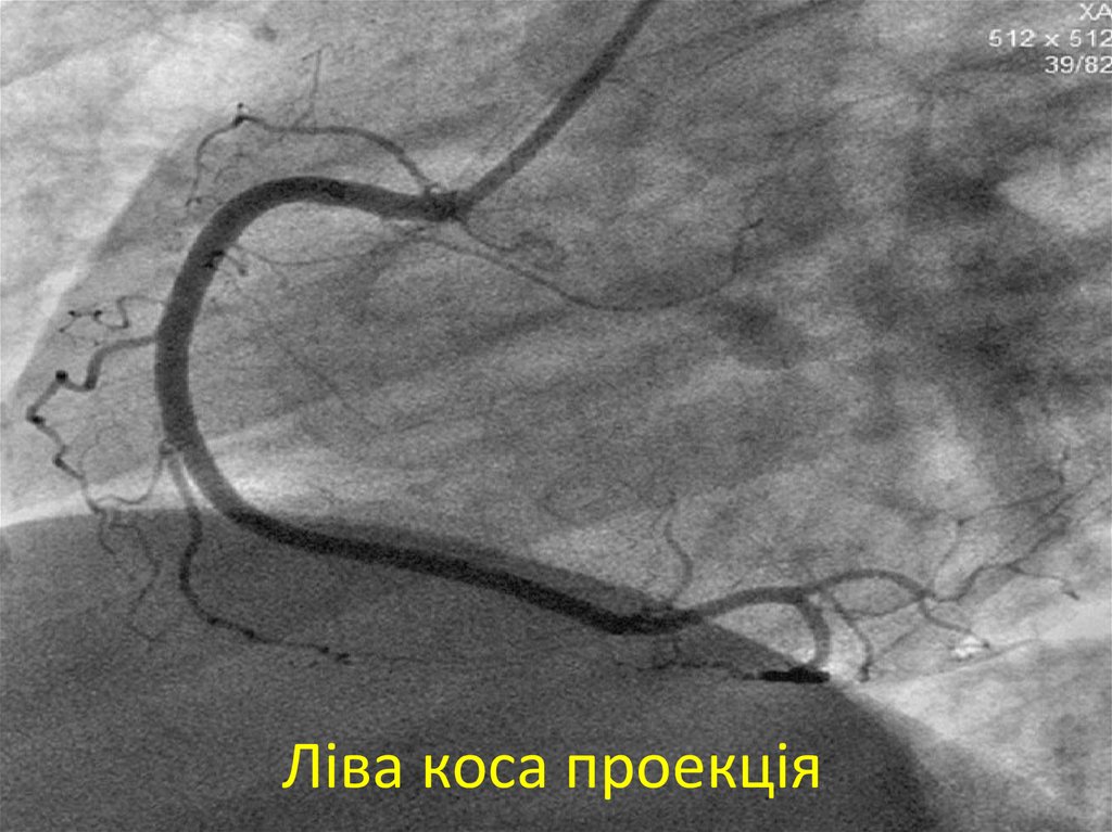 Ліва коса проекція