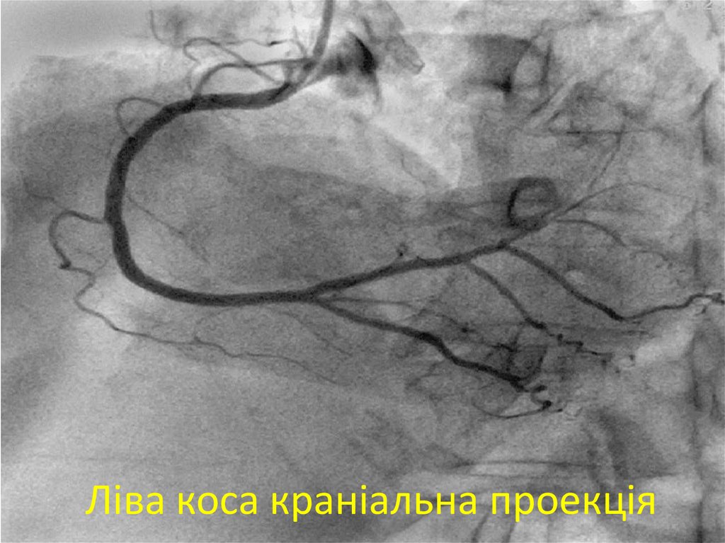 Ліва коса краніальна проекція