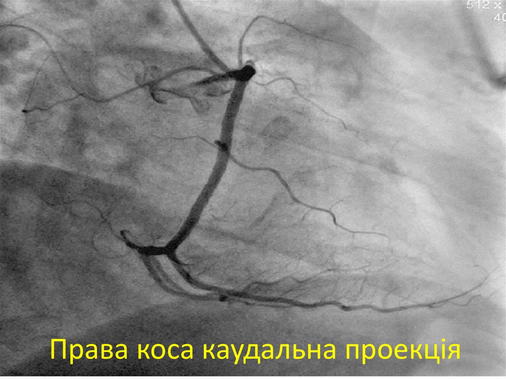 Права коса каудальна проекція