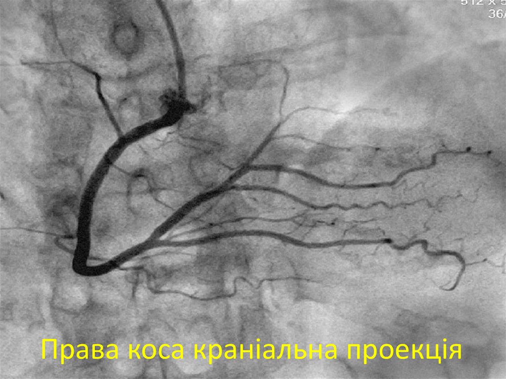 Права коса краніальна проекція