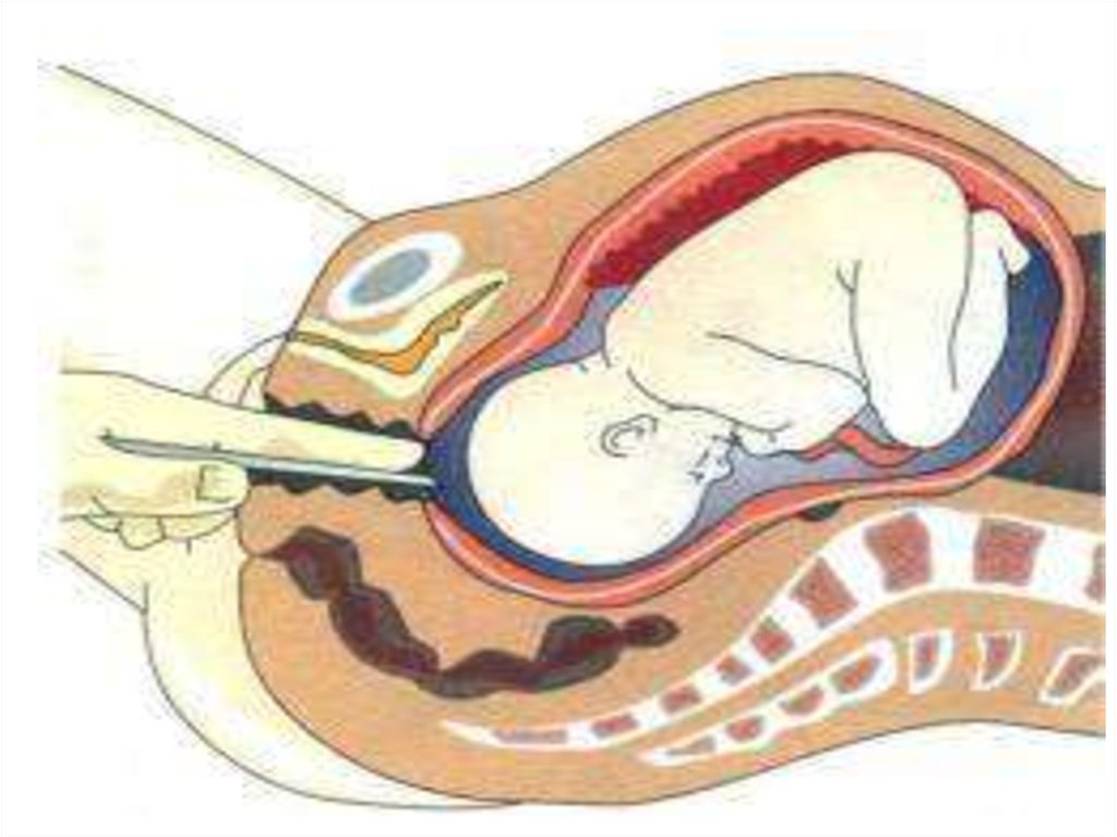 Роды через матку. Амниотомия (вскрытие плодного пузыря). Катетер Фолея в шейку матки. Катетер Фолея для стимуляции родов. Прокол пузыря амниотомия плодного.