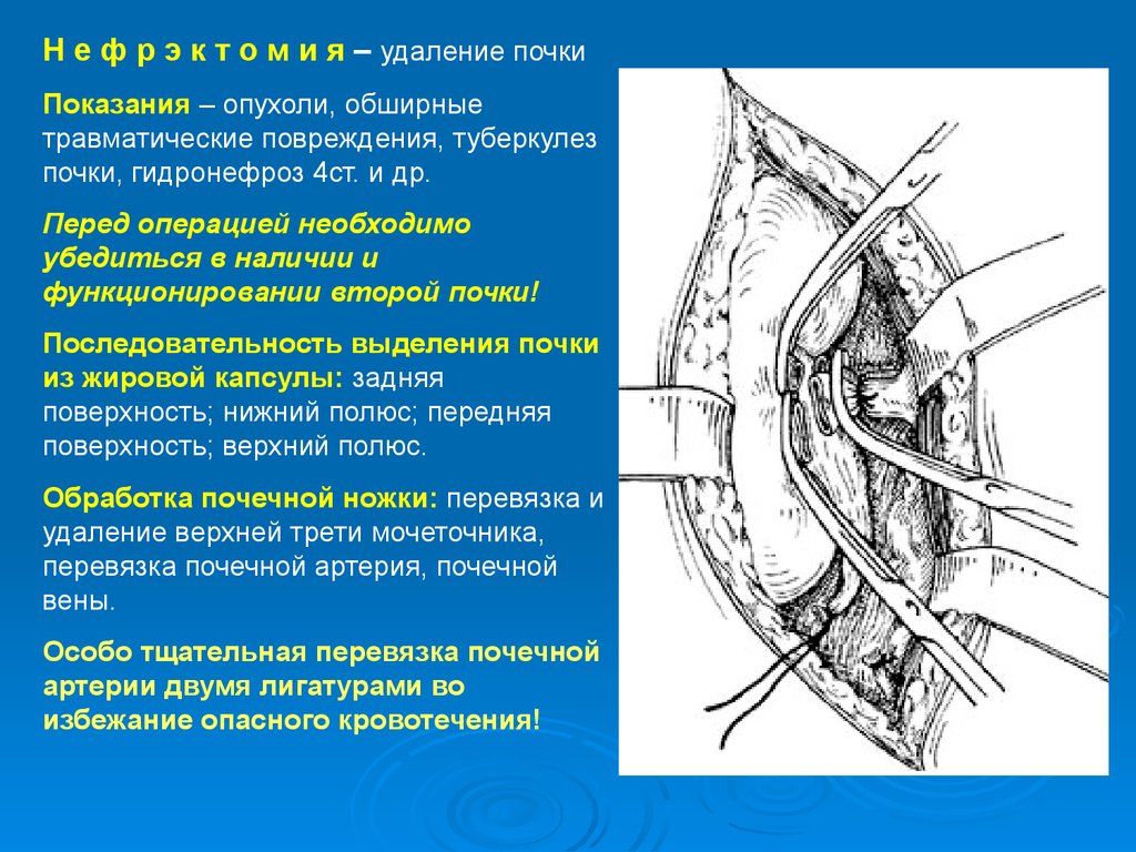 Резекция почки что это