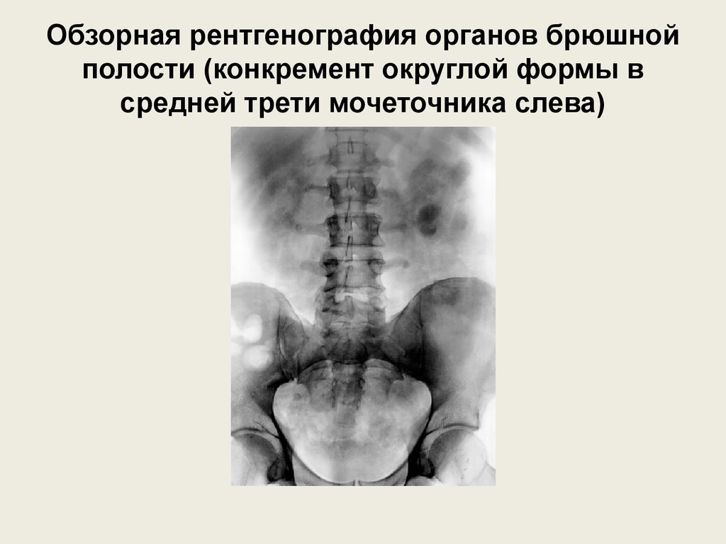 Обзорная рентгенография брюшной полости