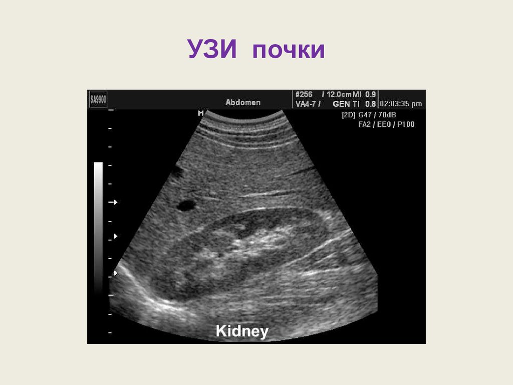 Узи картина мочекаменной болезни