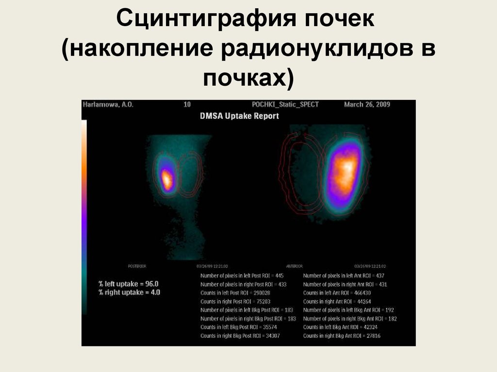 Сцинтиграмма является изображением