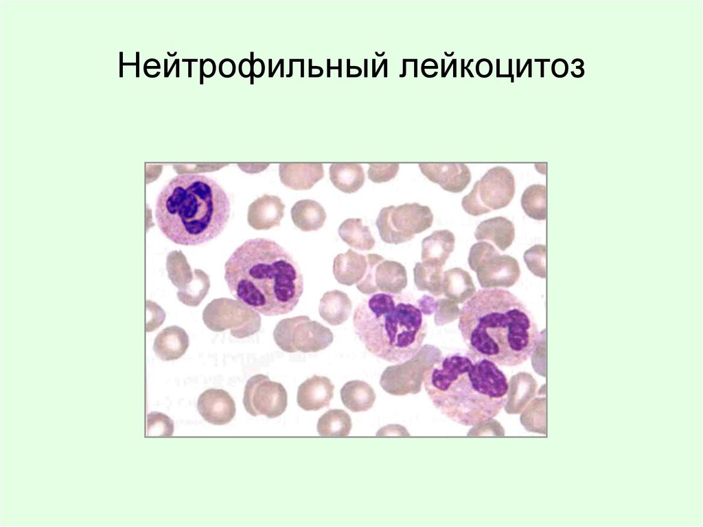 Лейкоцитоз нейтрофилез