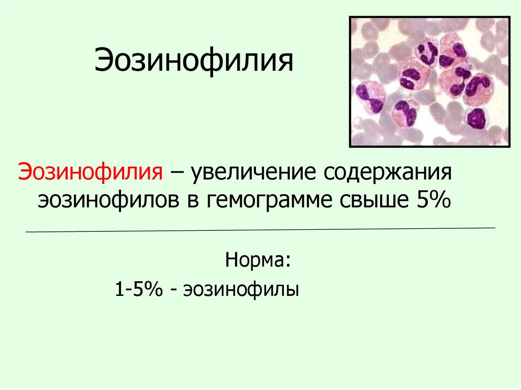 Эозинофилы в общем. Эозинофильный лейкоцитоз картина крови. Эозинофилия периферической крови. Норма эозинофилов в периферической крови. Повышение эозинофилов причины.
