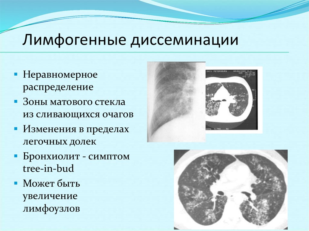 Лимфогенный туберкулез. Лимфогенный диссеминированный туберкулез кт. Диссеминированный туберкулез на кт. Диссеминированый туберкулёз на кт. Лимфогенно диссеминированный туберкулез кт.