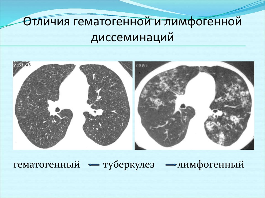 Лимфогенный туберкулез. Лимфогенно диссеминированный туберкулез кт. Хронический диссеминированный туберкулез легких кт. Милиарный туберкулез кт картина. Хронический диссеминированный туберкулез кт.