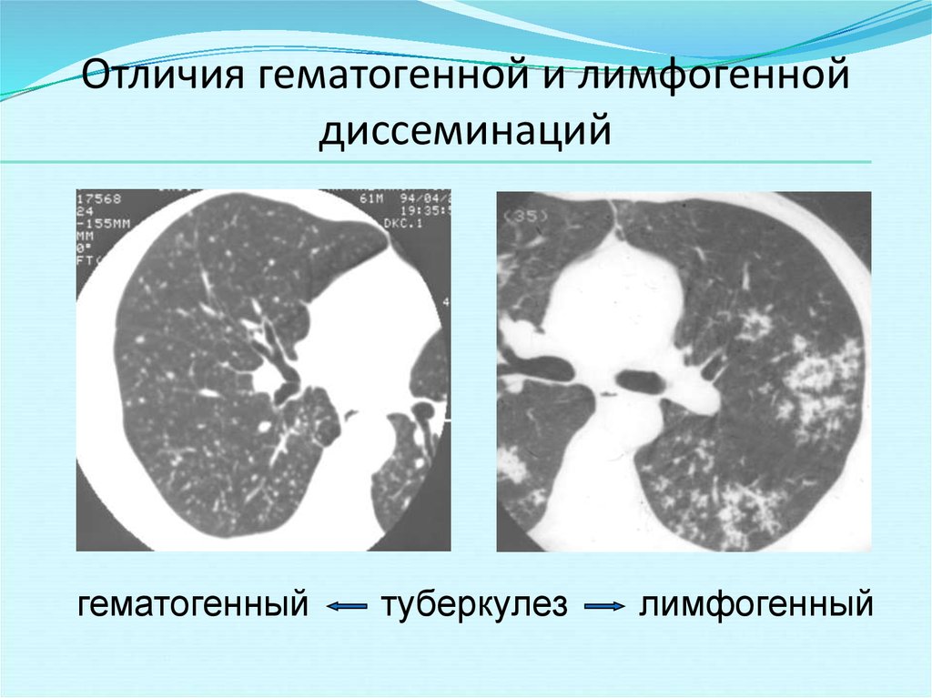 Лимфогенный туберкулез