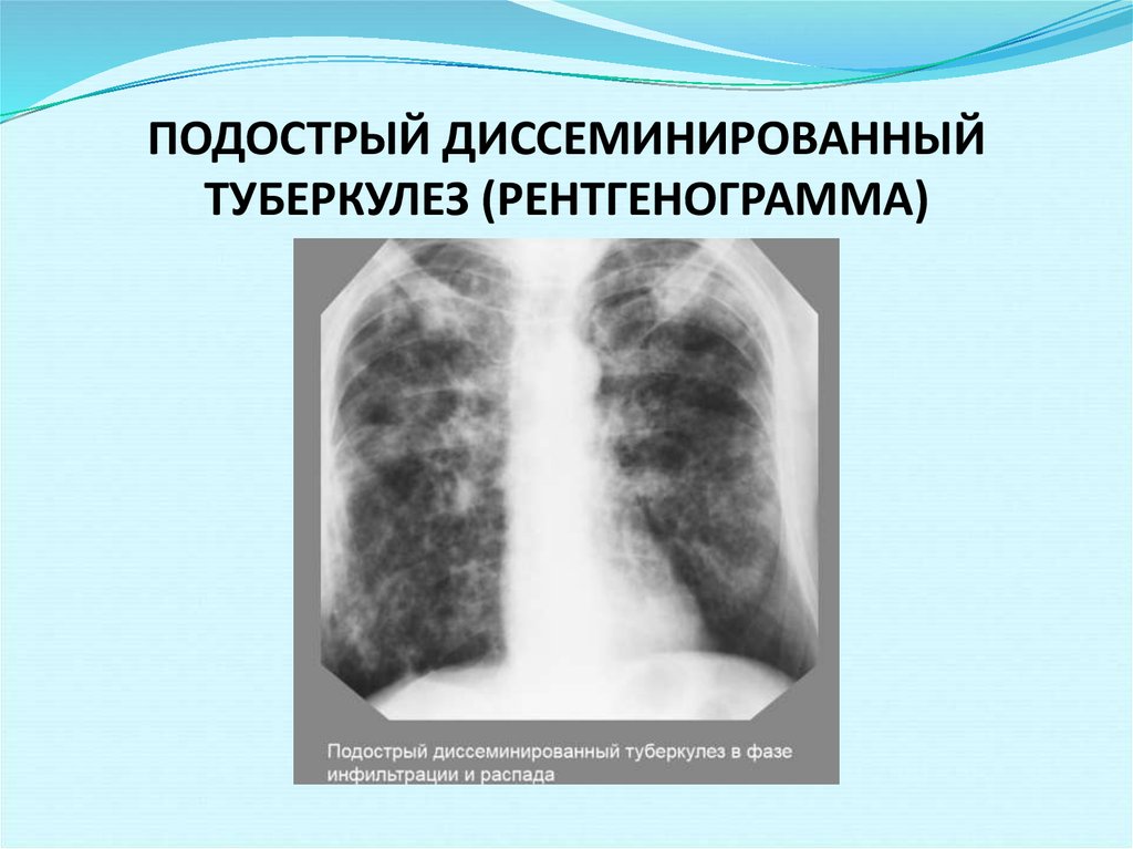 Острый диссеминированный туберкулез. Хронический диссеминированный туберкулез рентген. Диссеминированный туберкулезентген. Хронический диссеминированный туберкулез легких рентген. Подострый диссеминированный туберкулез рентген.