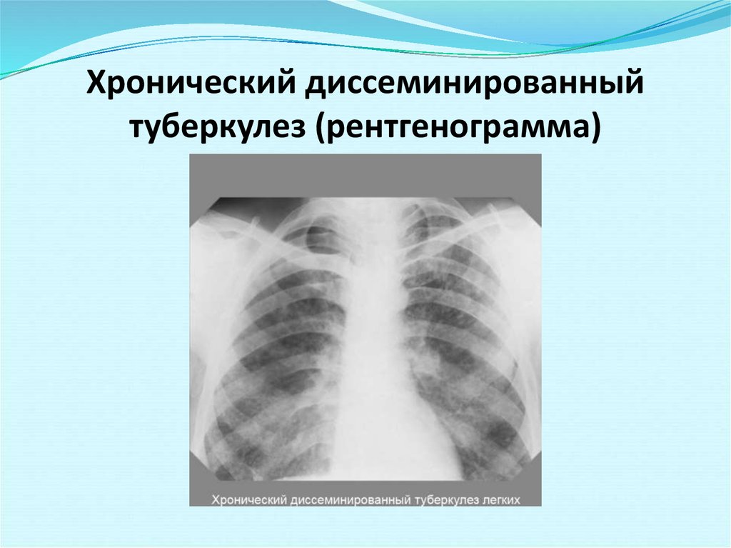 Туберкулез легкого рентгенограмма. Хронический диссеминированный туберкулез. Лимфогенный диссеминированный туберкулез. Диссеминированный туберкулез на рентгенограмме.