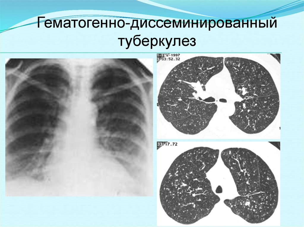 Острый диссеминированный туберкулез. Подострый диссеминированный туберкулез рентген. Острый диссеминированный туберкулез рентген. Подострый диссиминированный туберкулёз рентген. Лимфогенно диссеминированный туберкулез рентген.