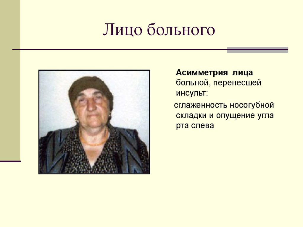 Лицо больного. Сглаженность носогубной складки. Сглаженность носогубной складки слева. Сглаженность носогубной складки при инсульте. Сглажена правая носогубная складка.