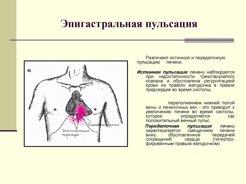 Пульсация в животе. Эпигастральная пульсация причины. Передаточная пульсация печени наблюдается при. Печеночная эпигастральная пульсация. Эминастральная пульсац я.