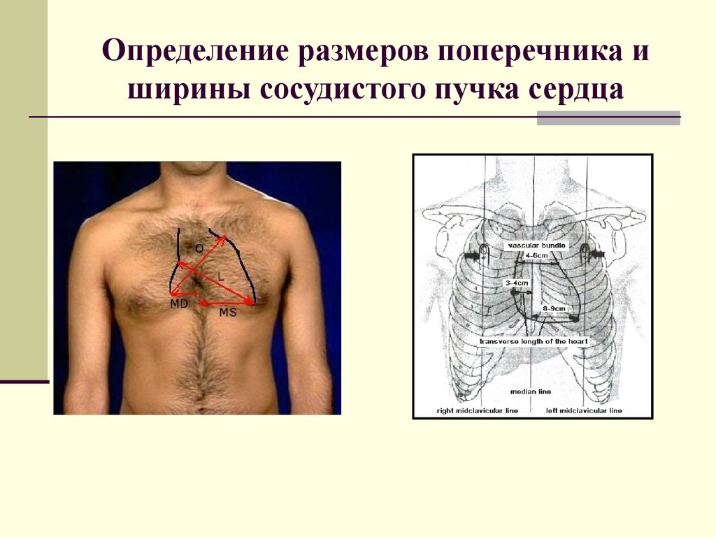 Сосудистые пучки это. Методика определения ширины сосудистого пучка. Поперечник сердца пропедевтика. Измерение поперечника сердца и ширины сосудистого пучка. Сосудистый пучок сердца.