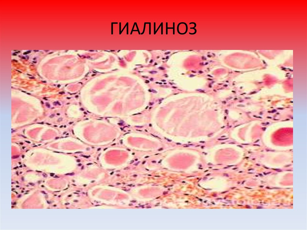 Мукоидоз дистрофия рисунок