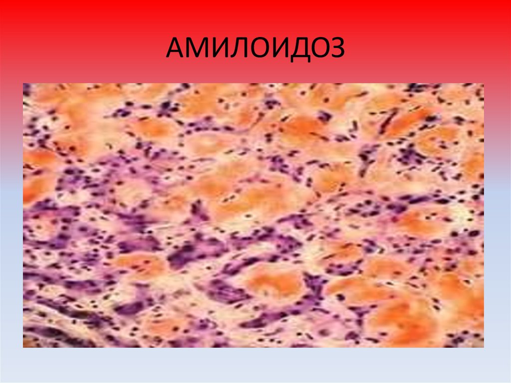 Мезенхимальные дистрофии это. Амилоидоз это белковая дистрофия. Мезенхимальные жировые дистрофии. Гиалиноз паренхиматозная дистрофия. Паренхиматозная белковая зернистая дистрофия.