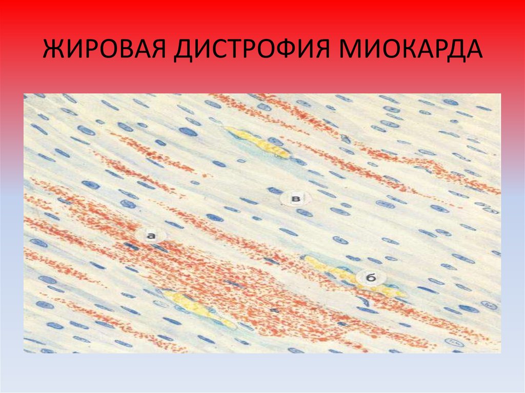 Дистрофия миокарда. Жировая дистрофия миокарда Судан 3. Жировая паренхиматозная дистрофия Мио. Мезенхимальная жировая дистрофия миокарда Судан макропрепарат. Жировая дистрофия миокарда Тигровое сердце.