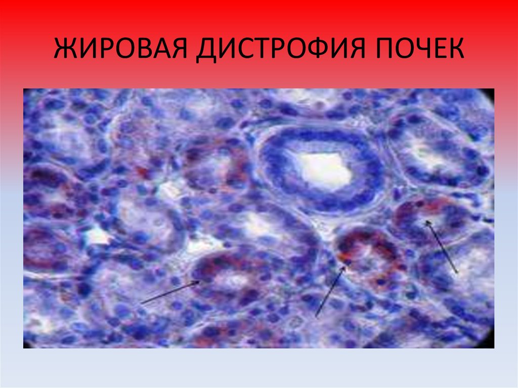 Опухоль с преобладанием паренхиматозной ткани. Белковая дистрофия эпителия канальцев. Жировая дистрофия почек микропрепарат. Клетка с зернистой дистрофией. Белковая дистрофия почки гистология.