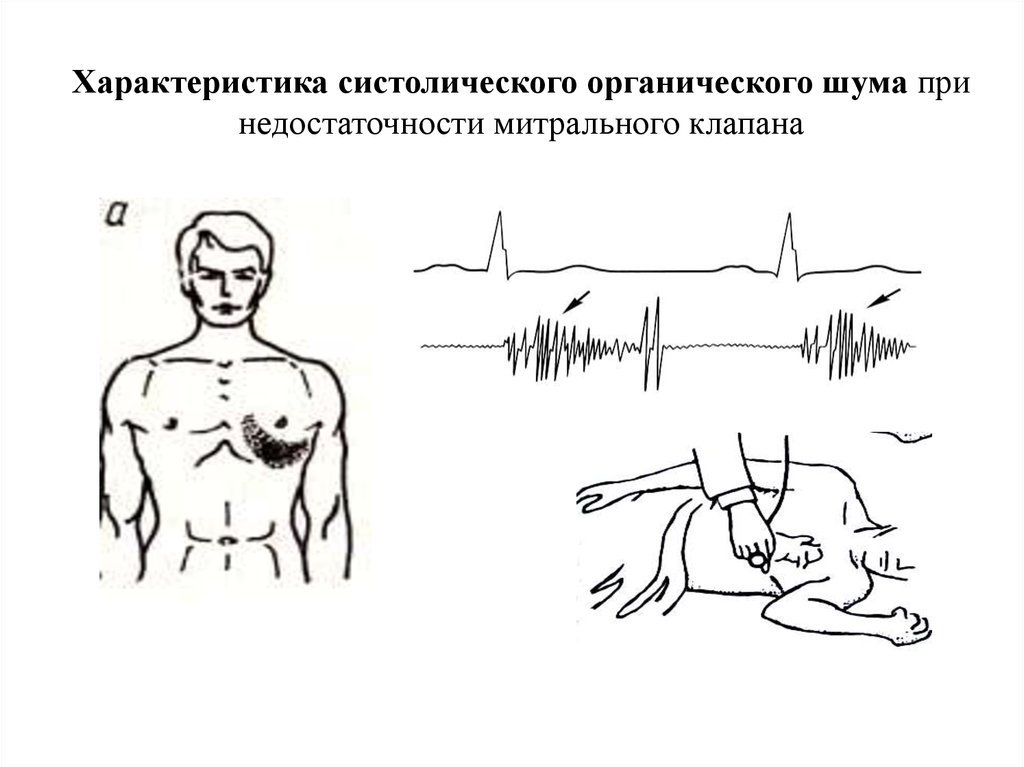 Причины недостаточности аортального клапана